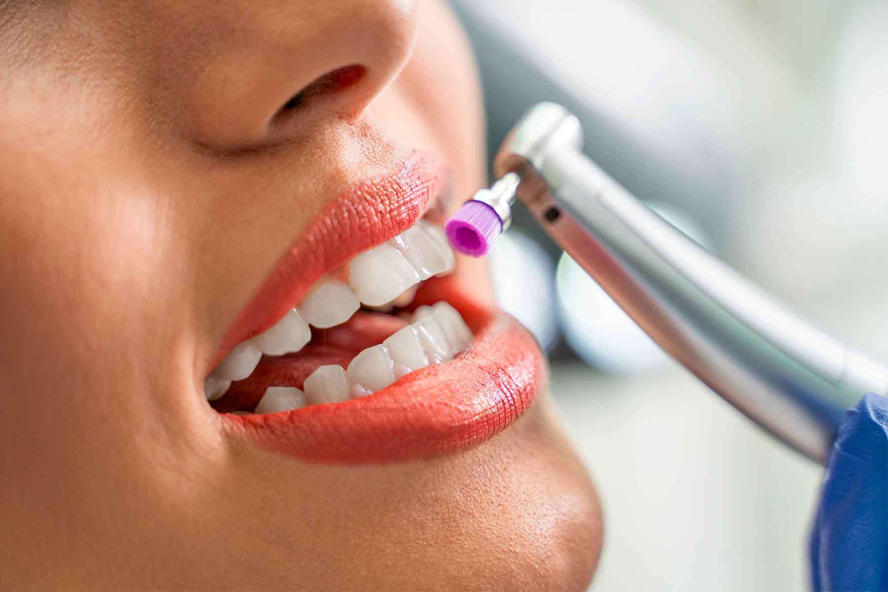 Limpieza Dental